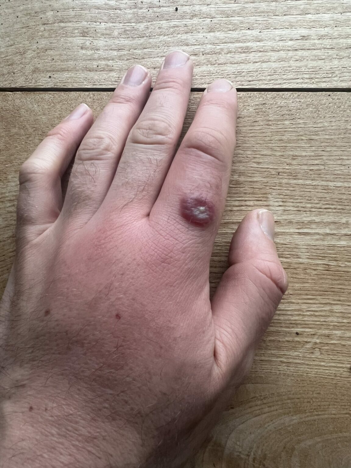 Infected cuts and bites from gardening Jack Wallington Nature & Gardens